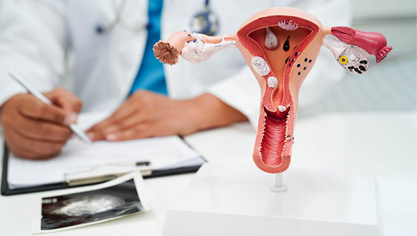 Endometriosis Diagnosed